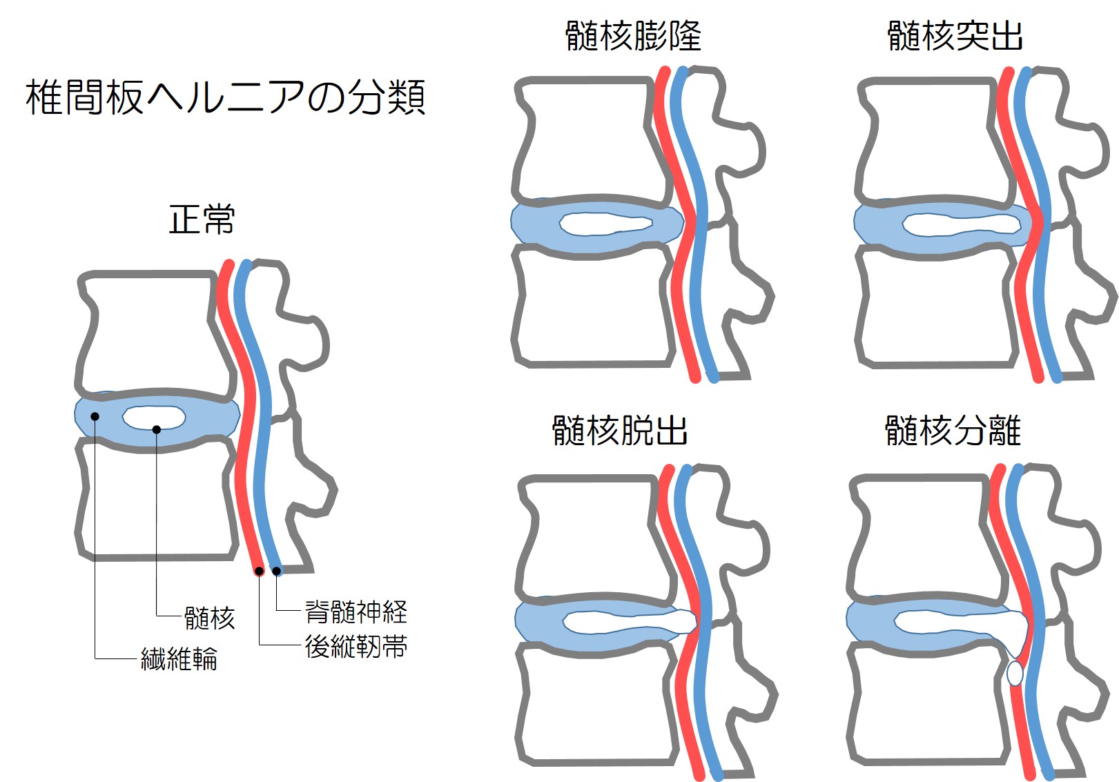 背中と足の痛み?椎間板ヘルニアとは何かを理解する